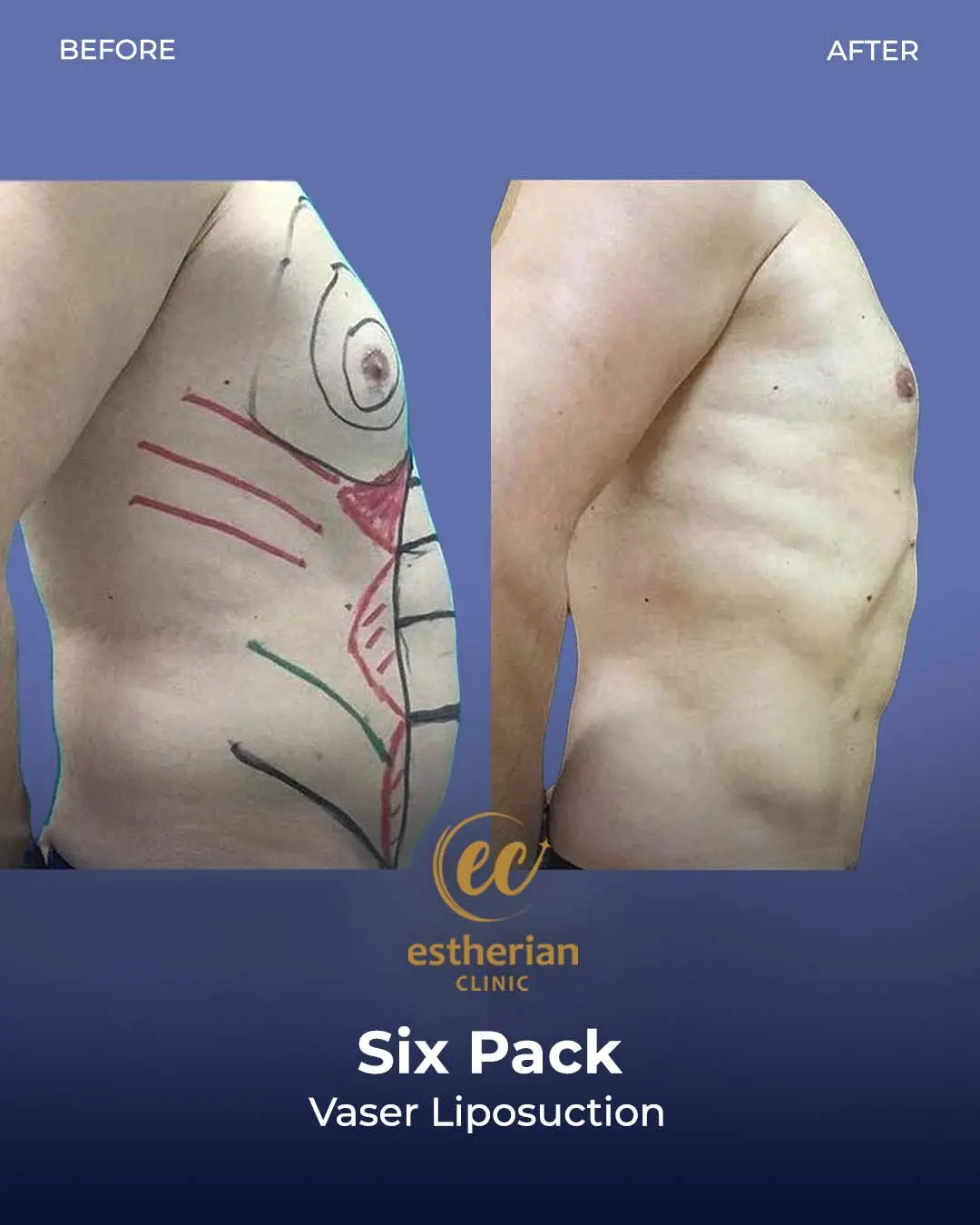 Six-pack liposuction before-and-after photo by the Estherian Clinic