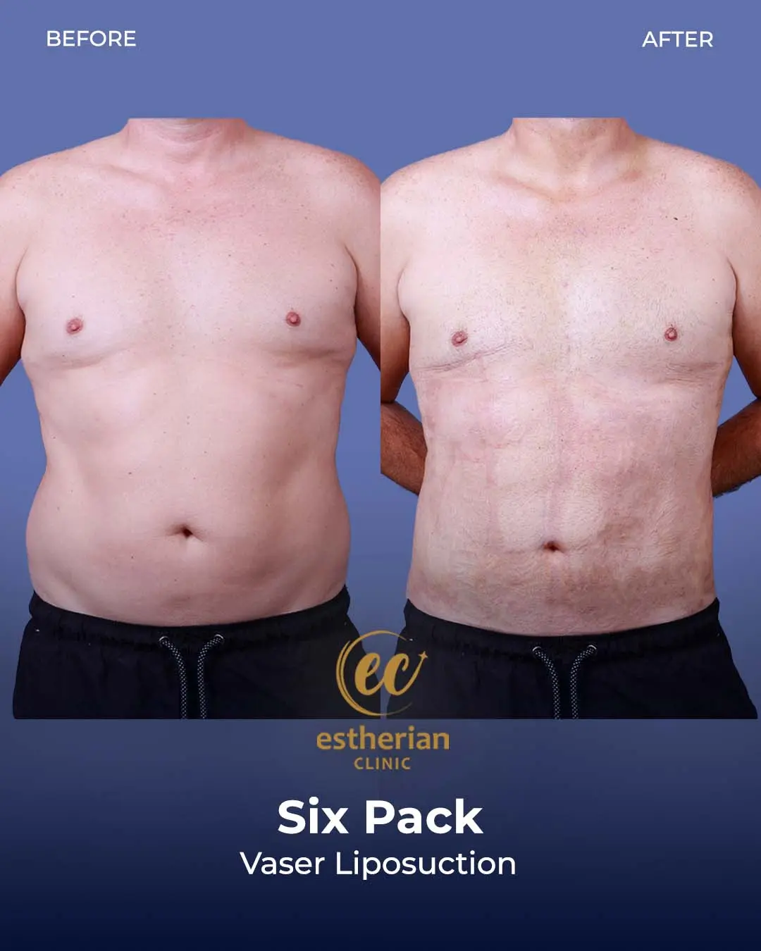 Six-pack liposuction before-and-after photo by the Estherian Clinic