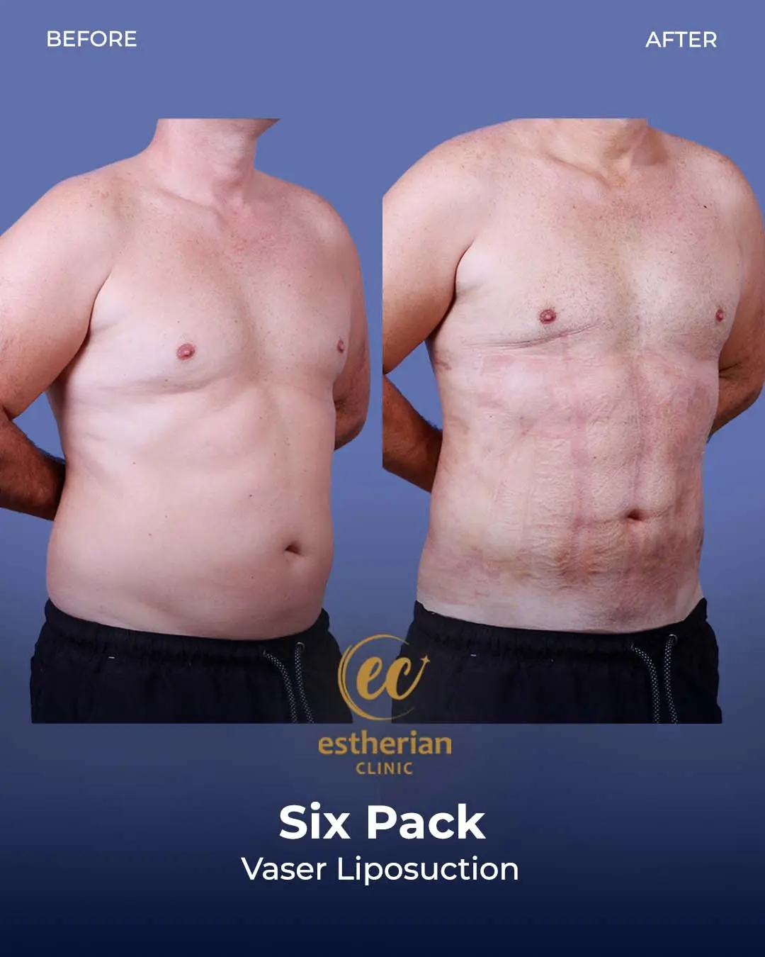 Six-pack liposuction before-and-after photo by the Estherian Clinic