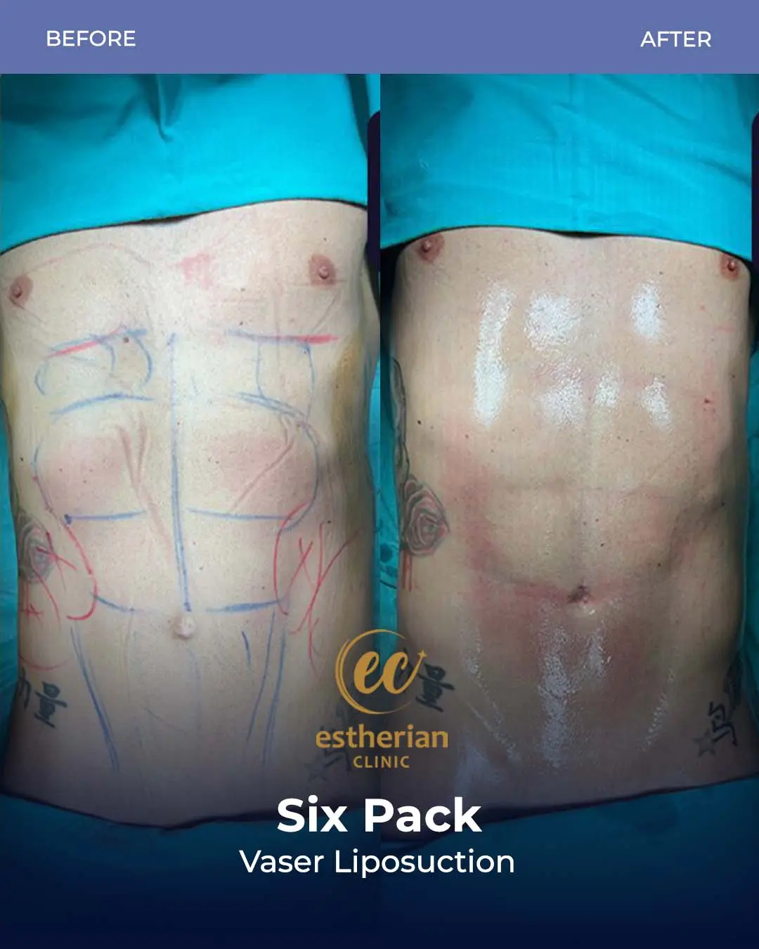 Six-pack liposuction before-and-after photo by the Estherian Clinic