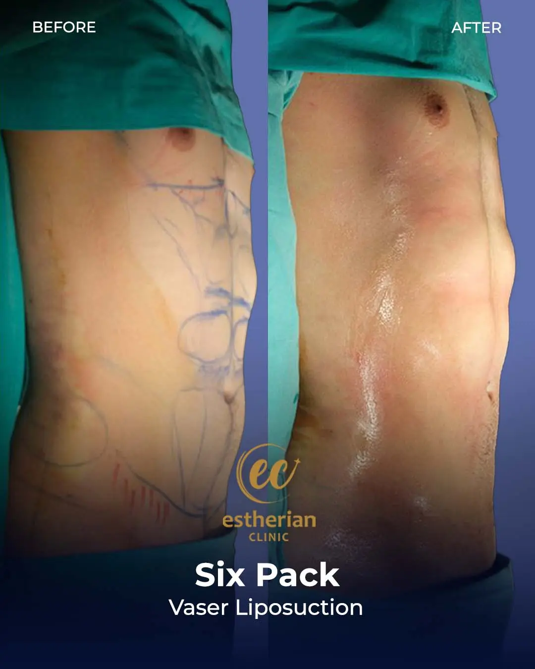 Six-pack liposuction before-and-after photo by the Estherian Clinic