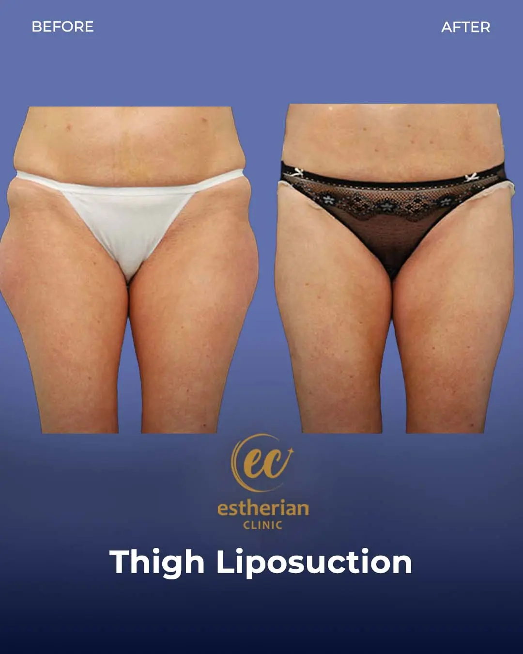 Thigh Liposuction and Lift by the Estherian Clinic