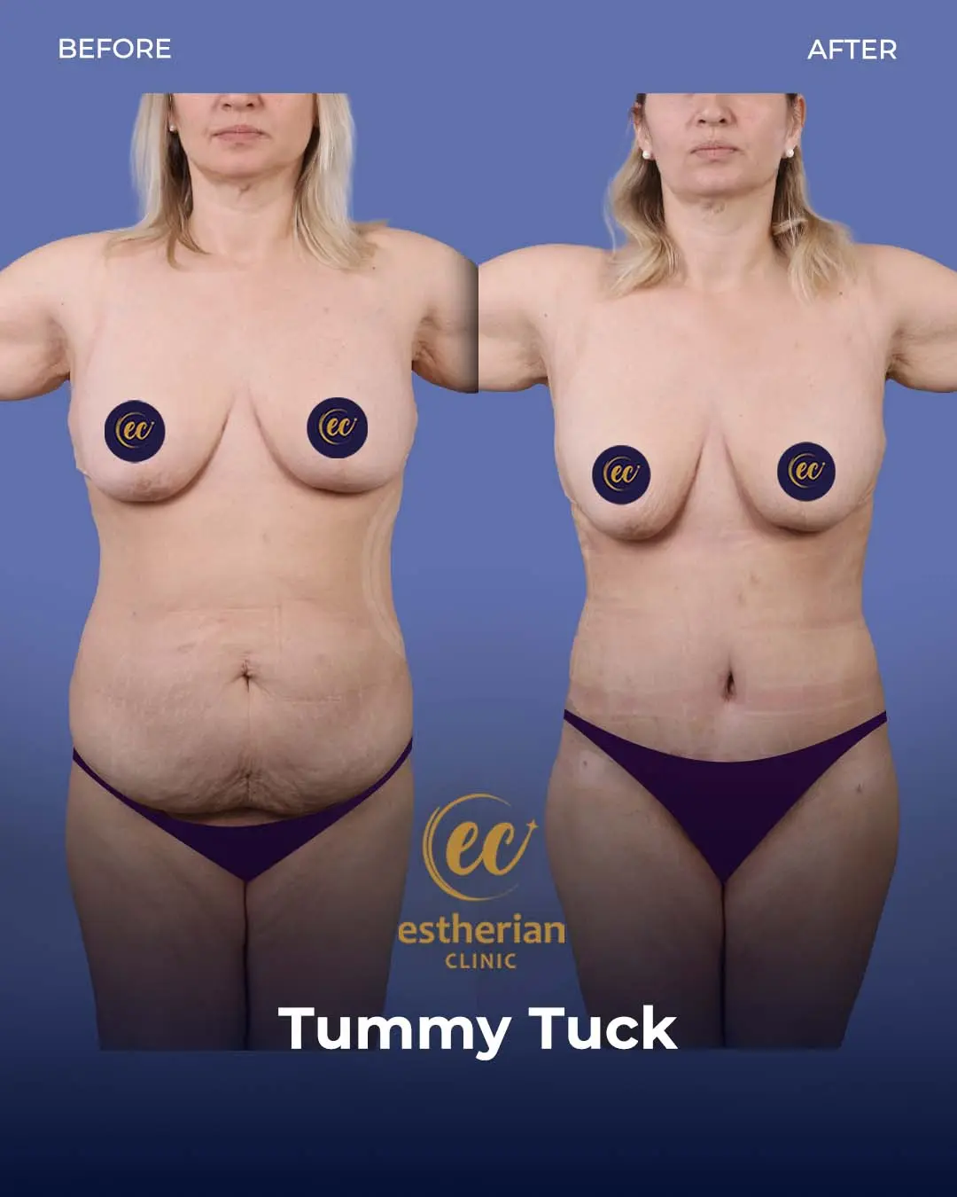 Tummy Tuck Before and after by the Estherian Clinic