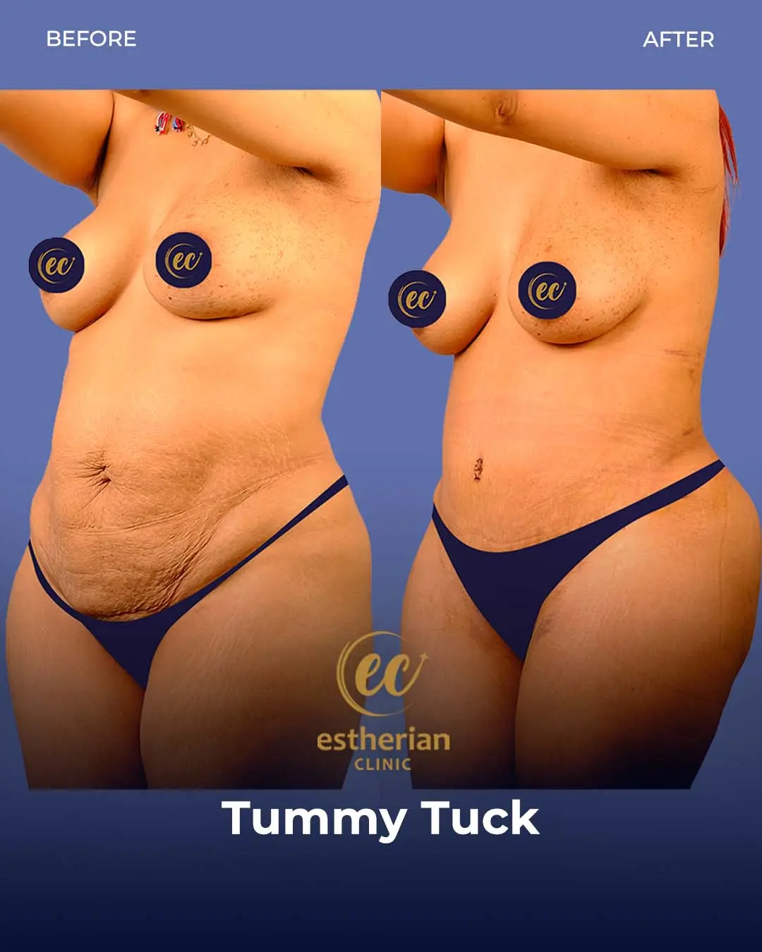 Tummy Tuck Before and after by the Estherian Clinic