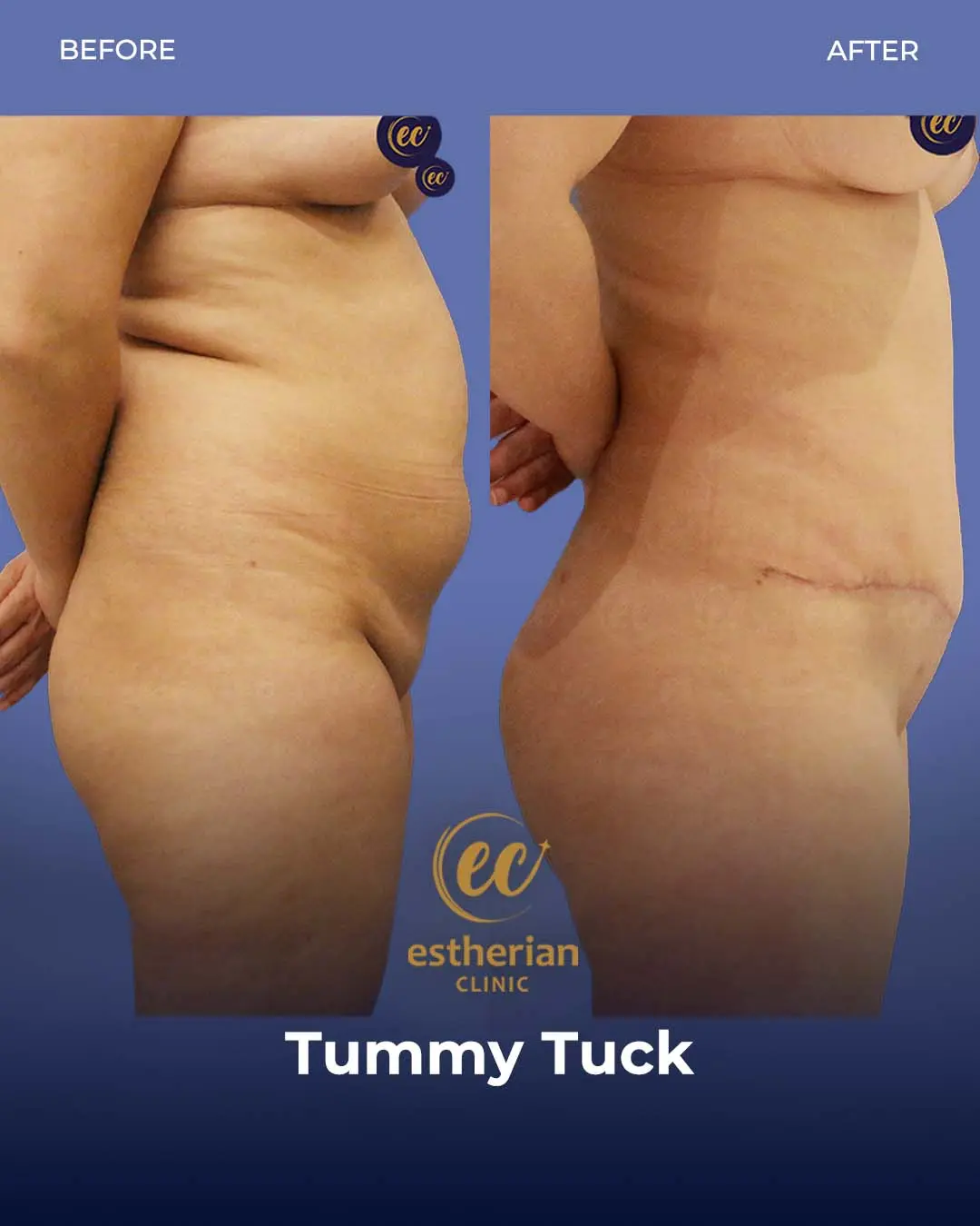 Tummy Tuck Before and after by the Estherian Clinic
