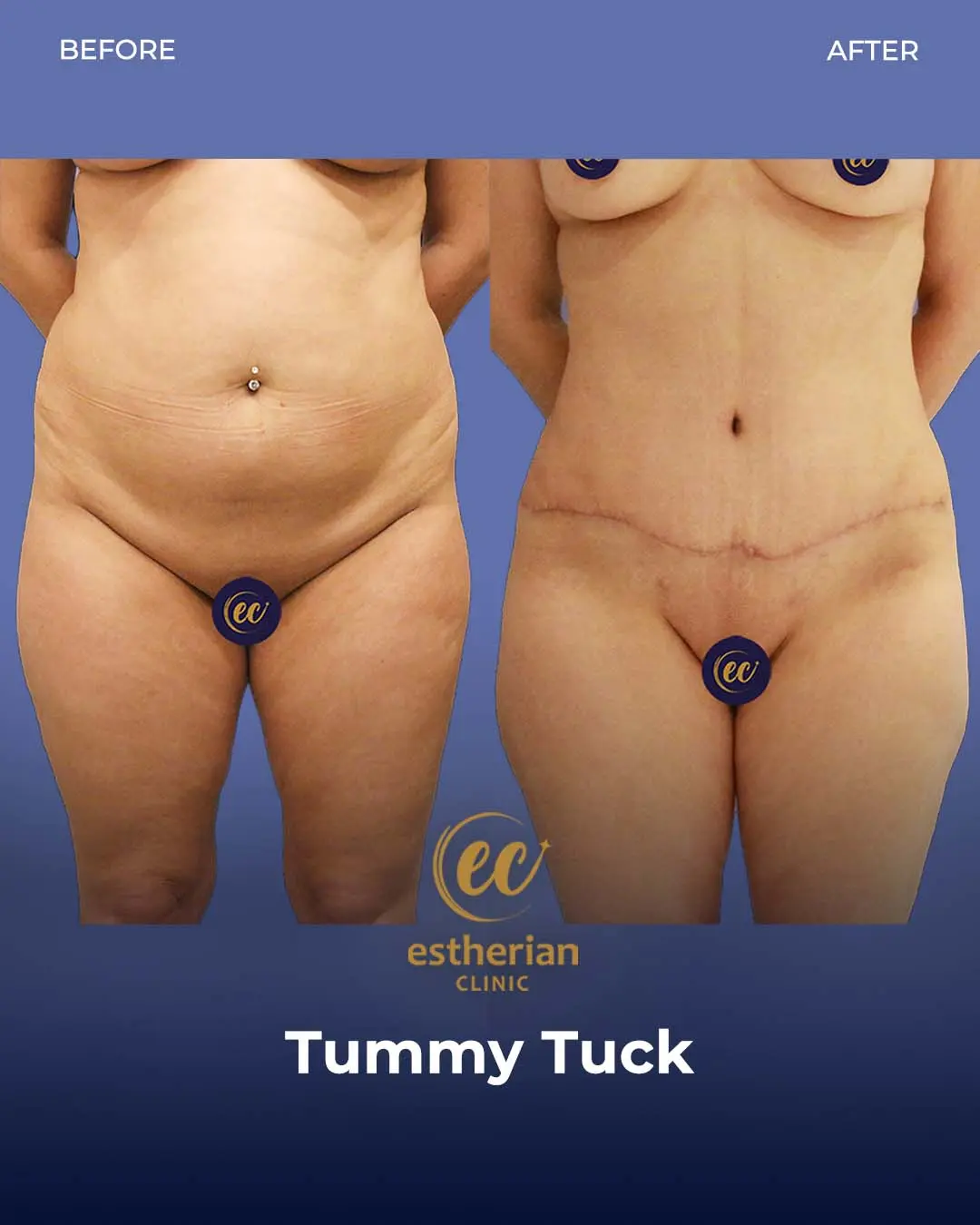 Tummy Tuck Before and after by the Estherian Clinic