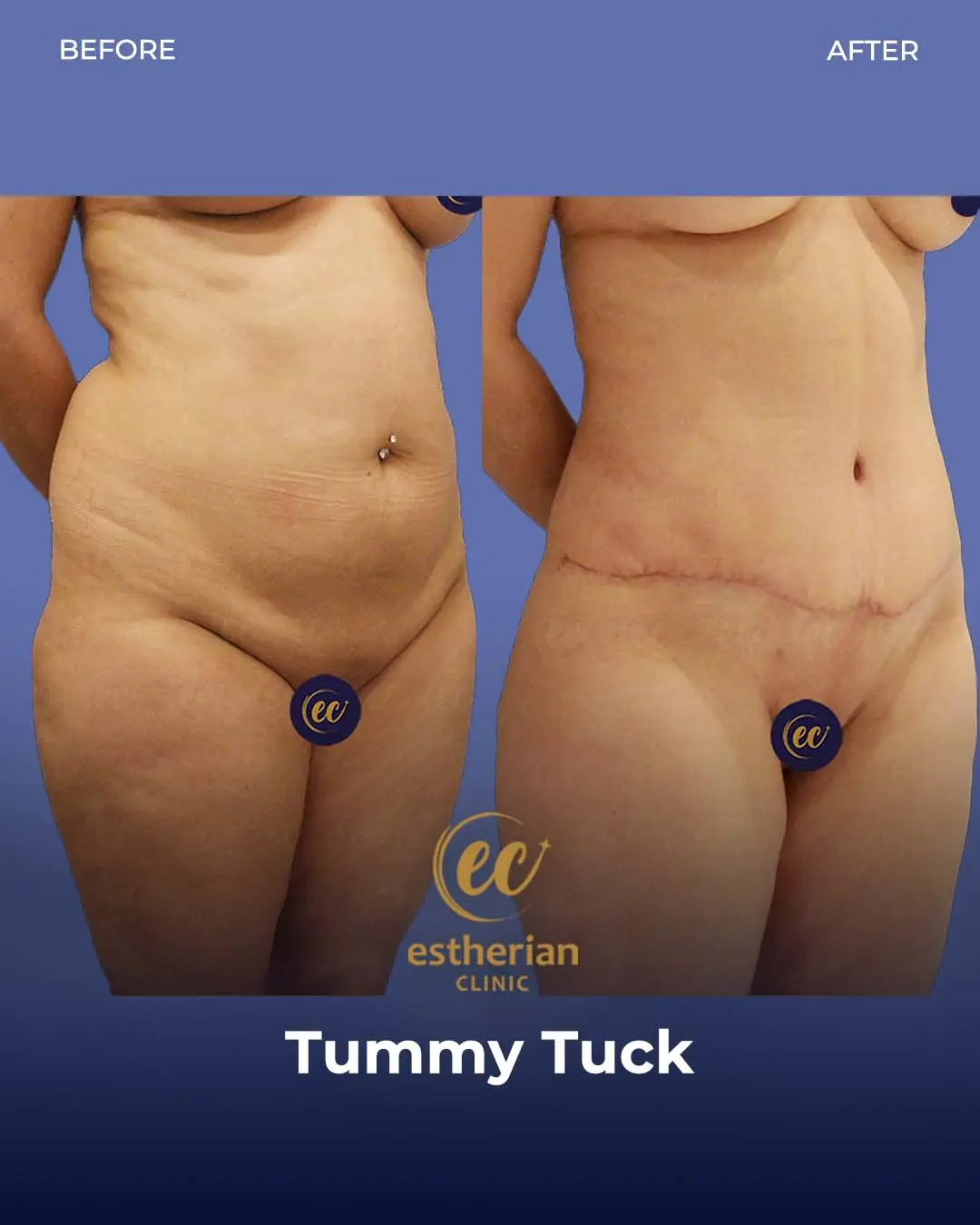 Tummy Tuck Before and after by the Estherian Clinic