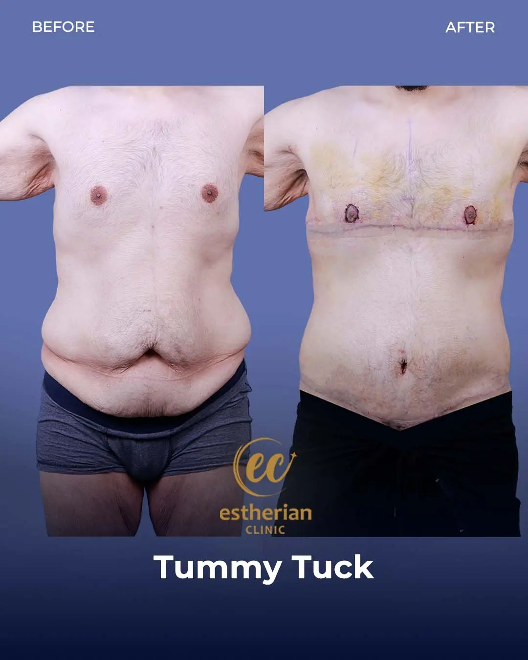 Tummy Tuck Before and after by the Estherian Clinic