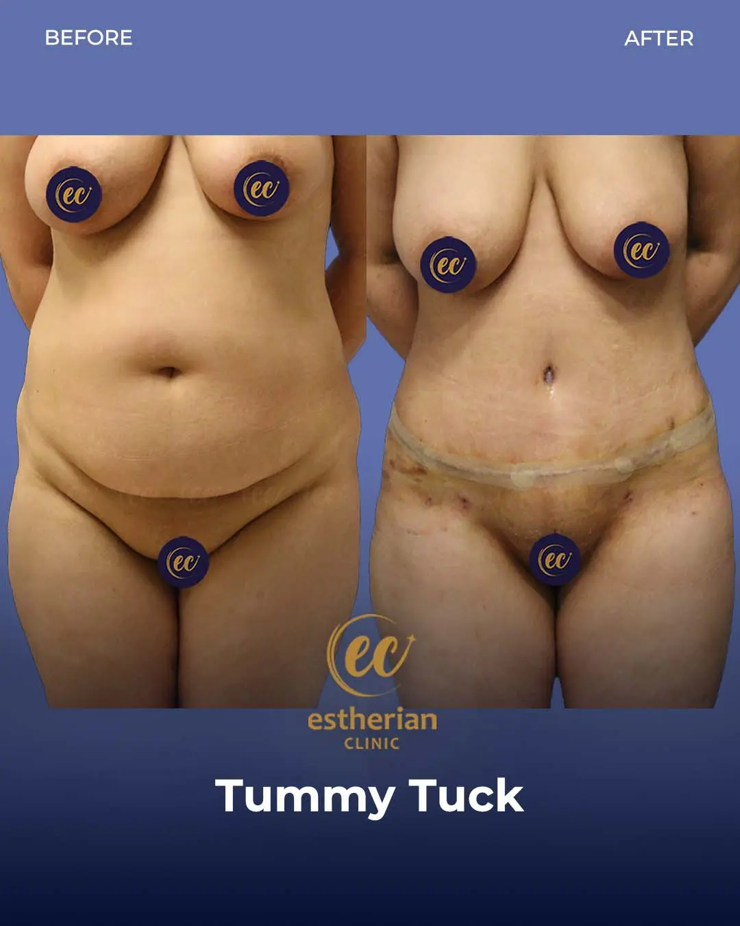 Tummy Tuck Before and after by the Estherian Clinic