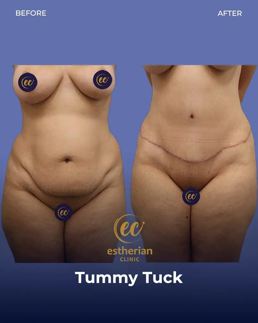 Tummy Tuck Before and after by the Estherian Clinic