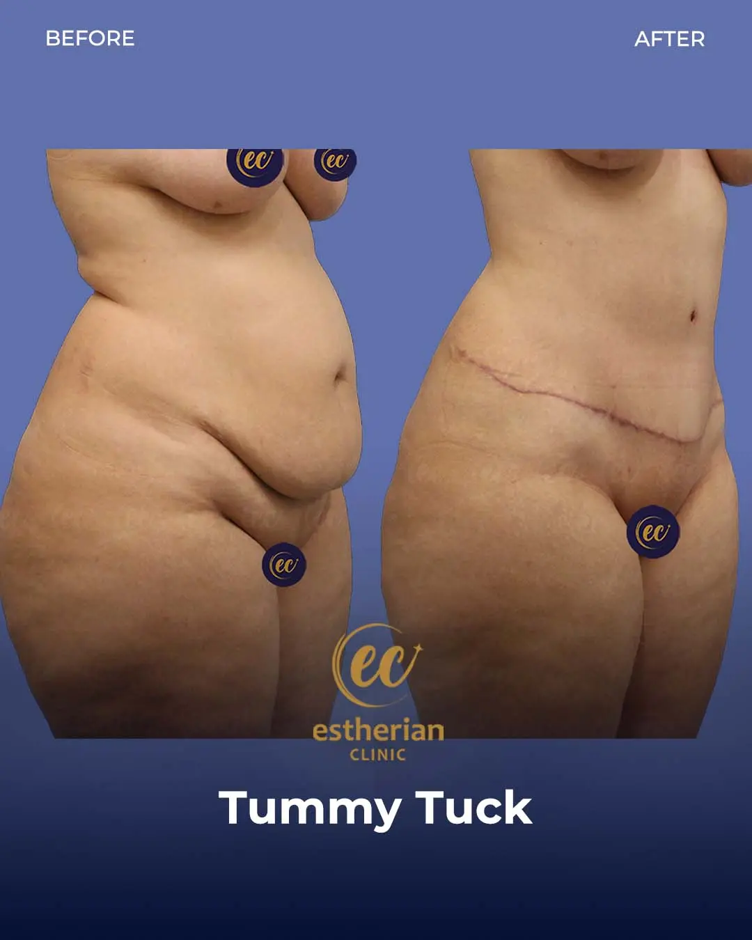Tummy Tuck Before and after by the Estherian Clinic