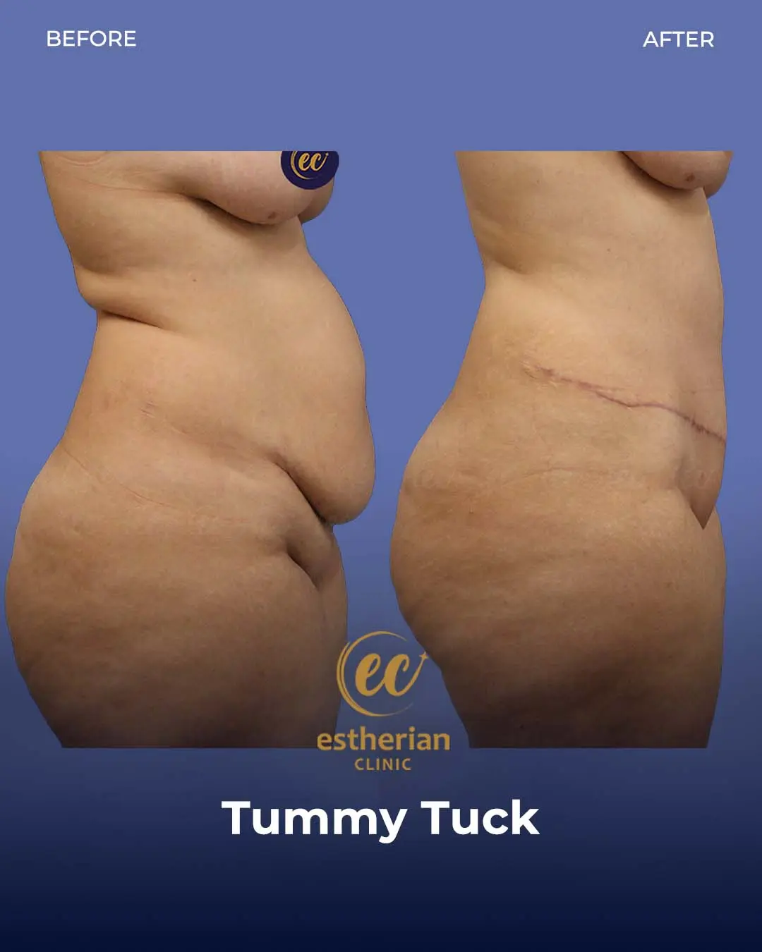 Tummy Tuck Before and after by the Estherian Clinic