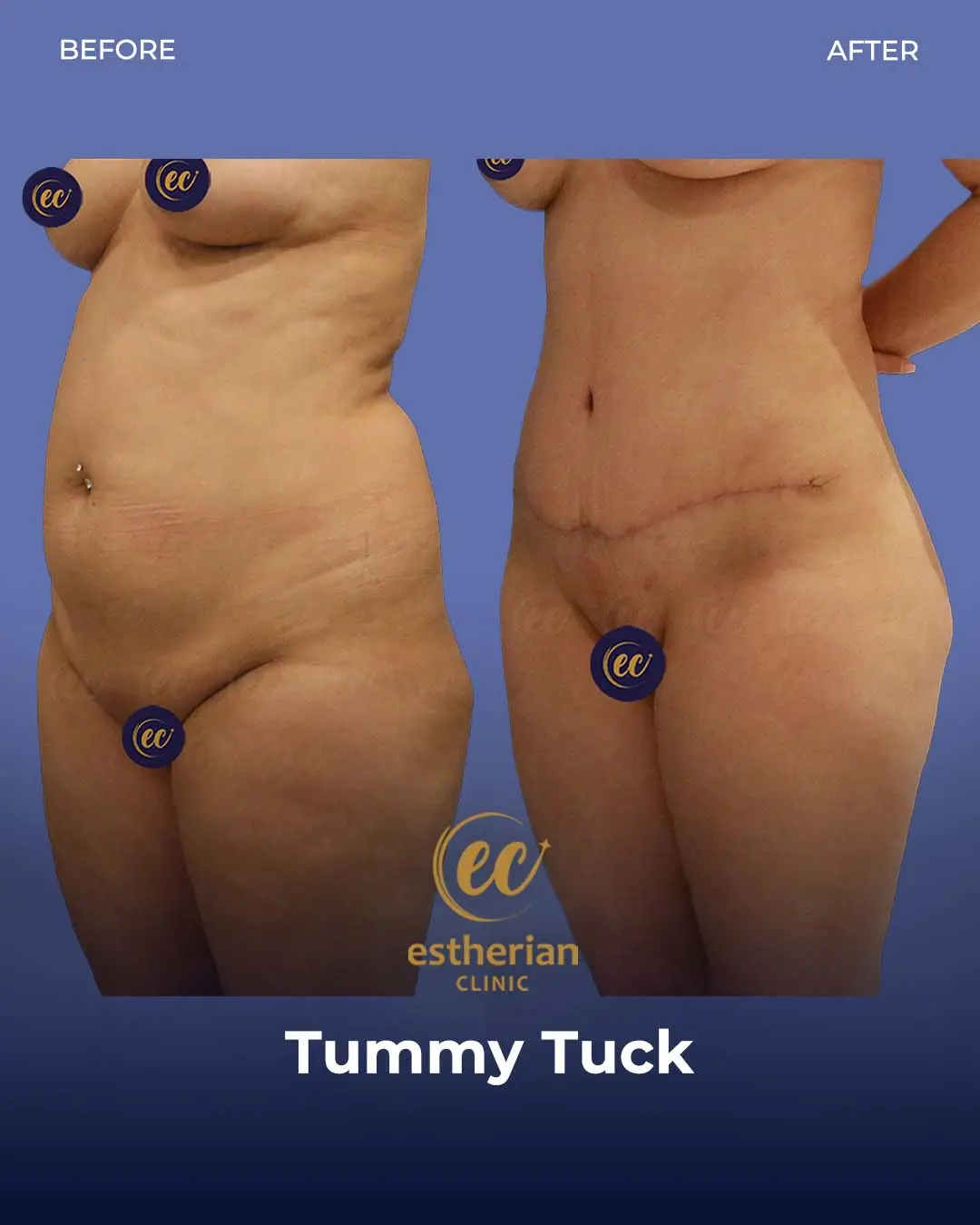 Tummy Tuck Before and after by the Estherian Clinic