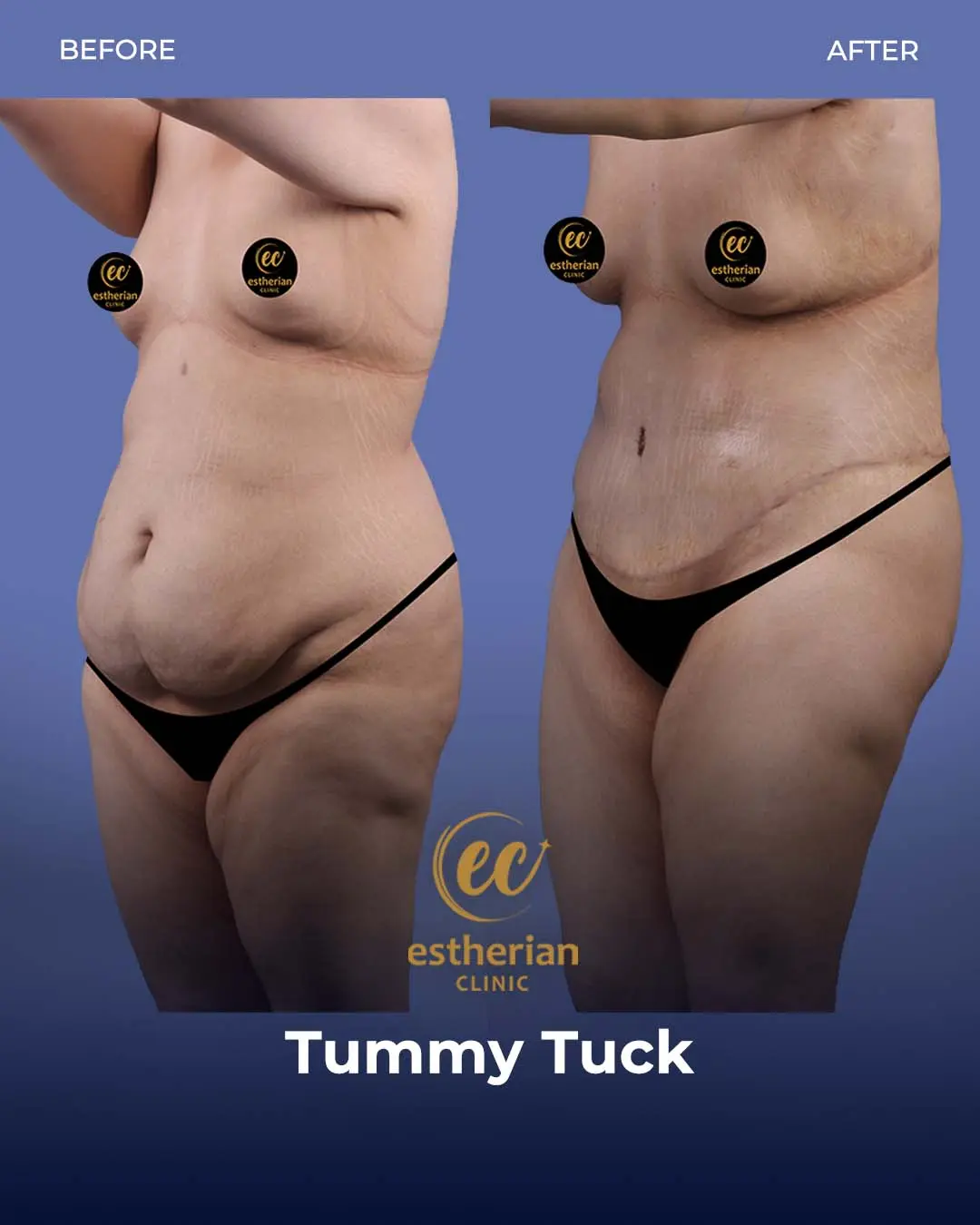 Tummy Tuck Before and after by the Estherian Clinic