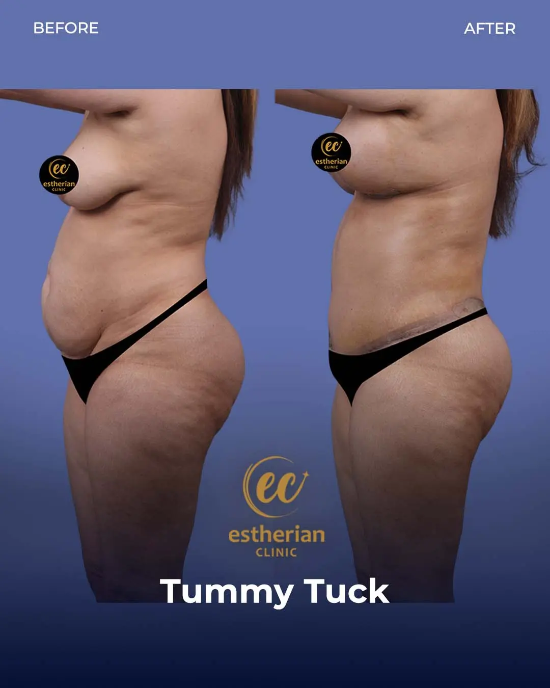 Tummy Tuck Before and after by the Estherian Clinic