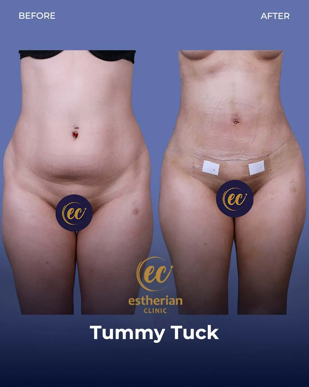 Tummy Tuck Before and after by the Estherian Clinic