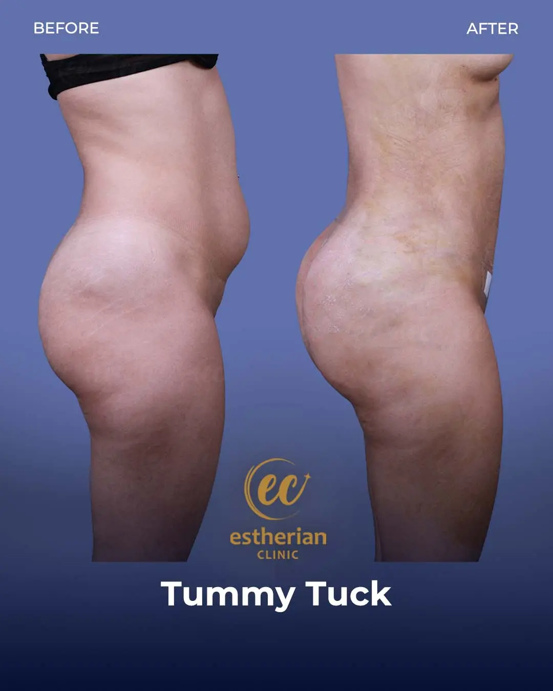 Tummy Tuck Before and after by the Estherian Clinic