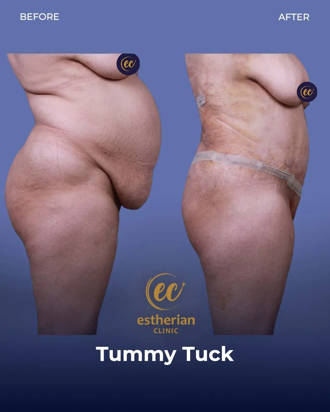 Tummy Tuck Before and after by the Estherian Clinic