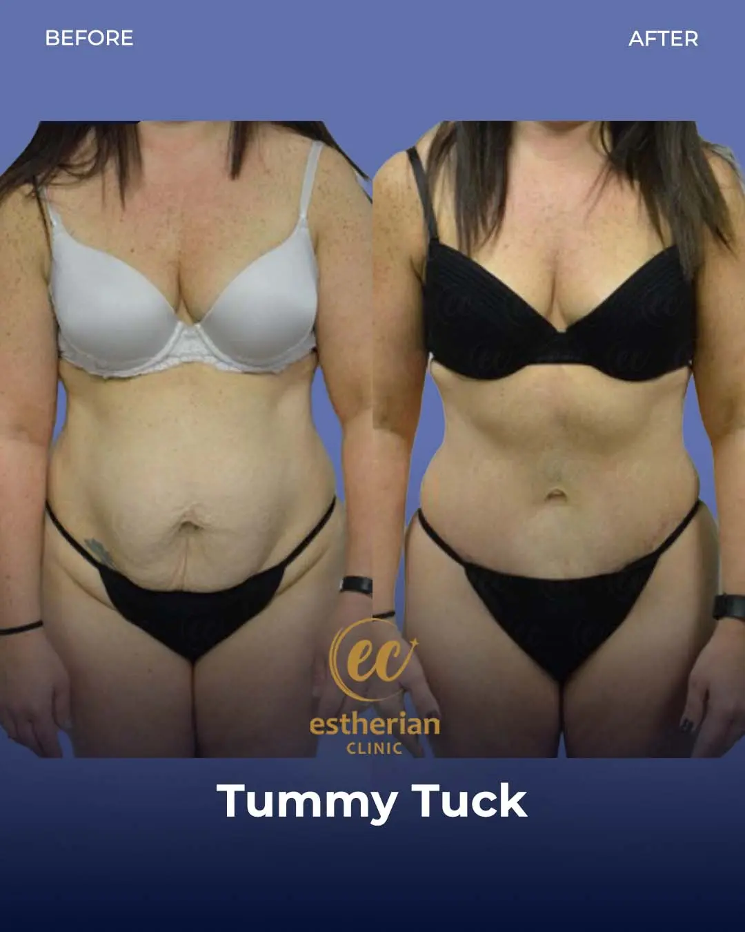 Tummy Tuck Before and after by the Estherian Clinic