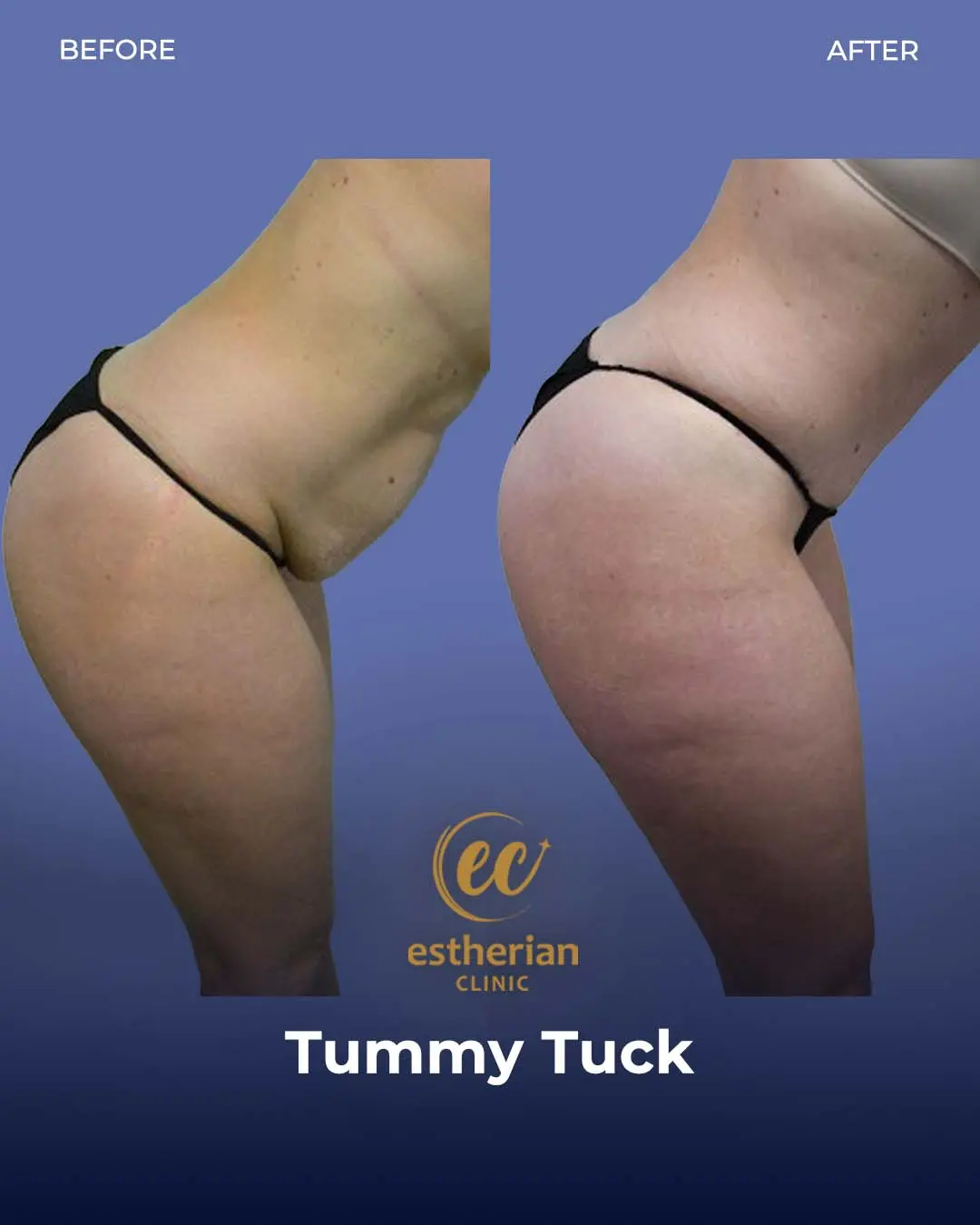 Tummy Tuck Before and after by the Estherian Clinic