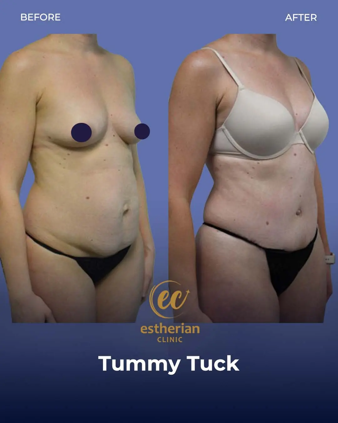 Tummy Tuck Before and after by the Estherian Clinic