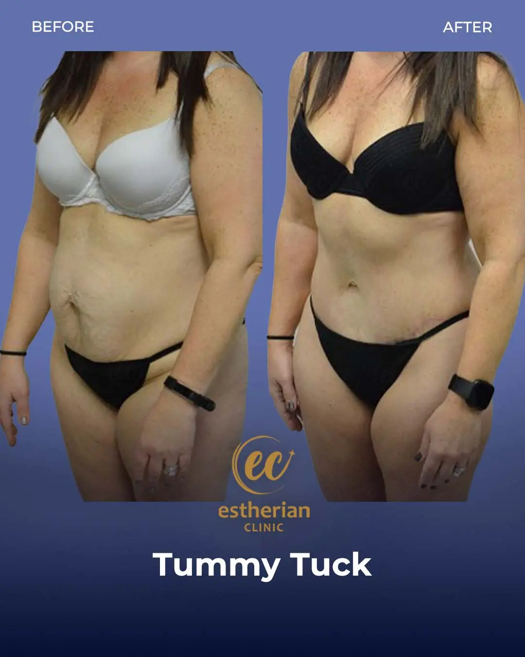 Tummy Tuck Before and after by the Estherian Clinic
