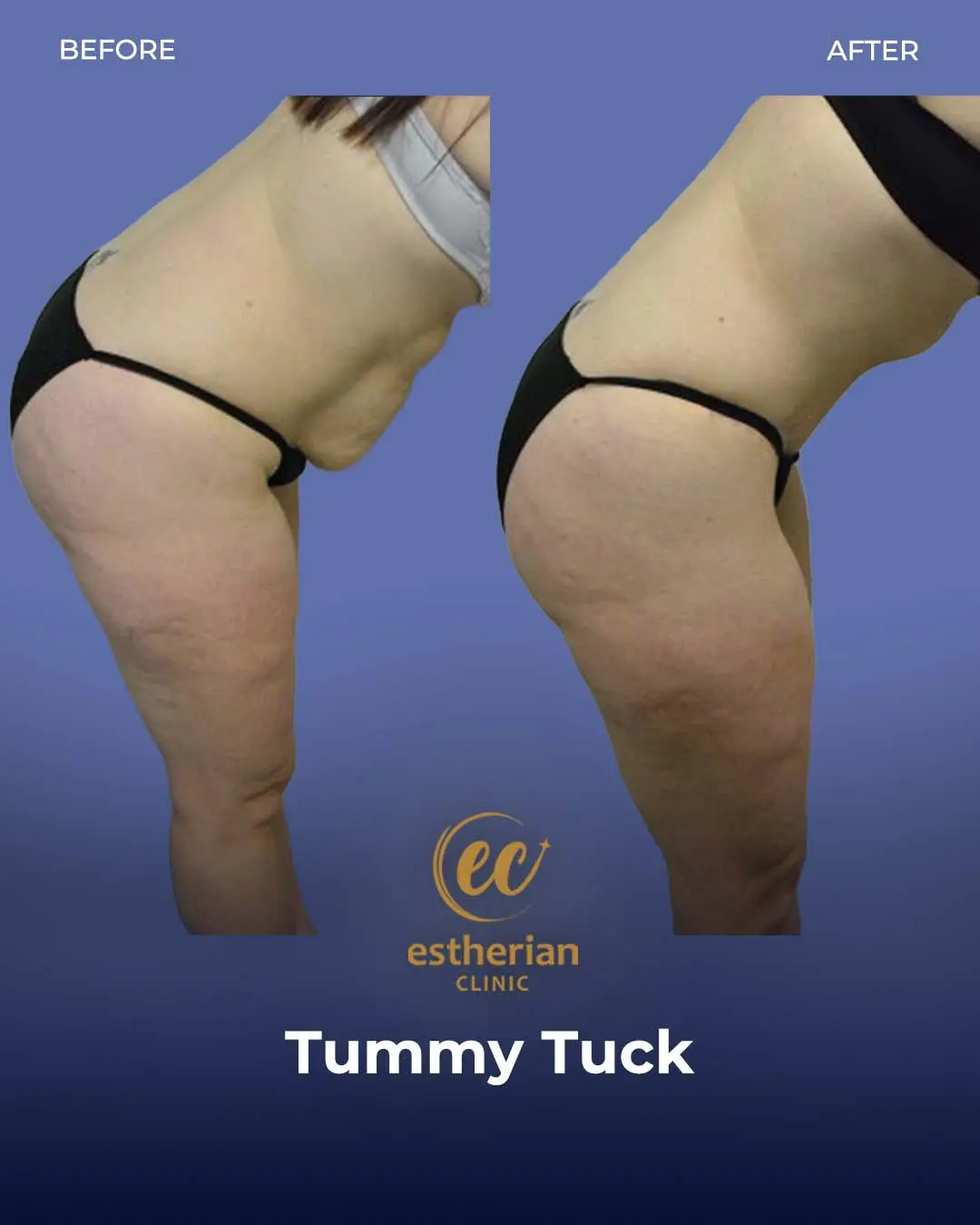 Tummy Tuck Before and after by the Estherian Clinic