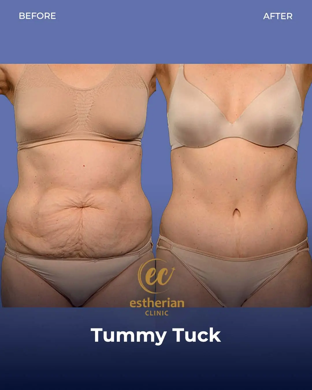 Tummy Tuck Before and after by the Estherian Clinic