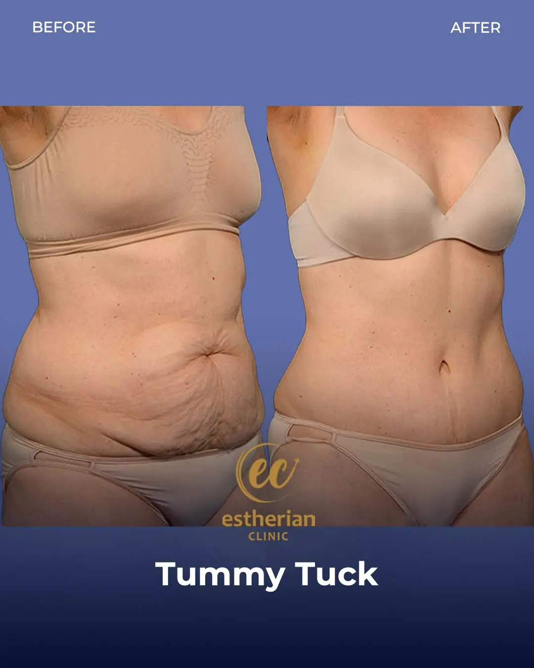 Male Tummy Tuck Before and after by the Estherian Clinic