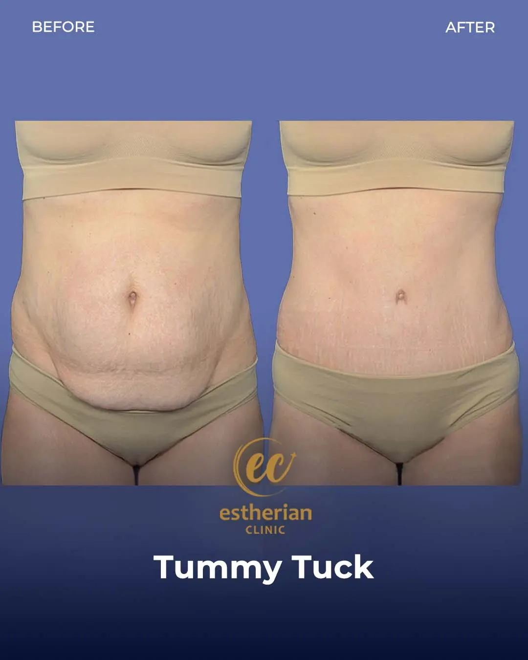 Tummy Tuck Before and after by the Estherian Clinic