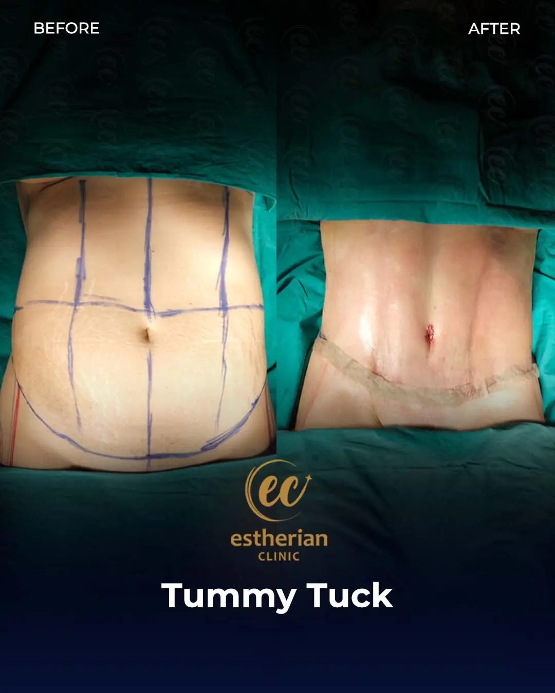 Tummy Tuck Before and after by the Estherian Clinic