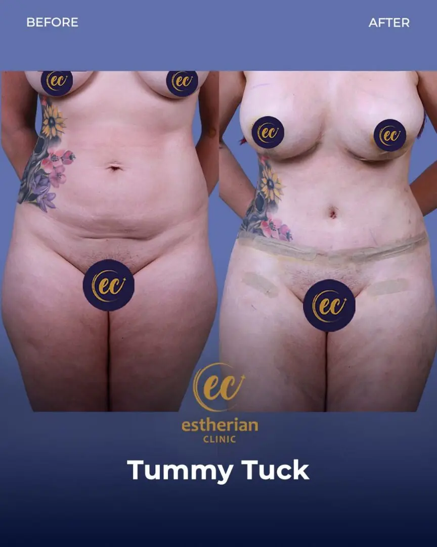 Tummy Tuck Before and after by the Estherian Clinic