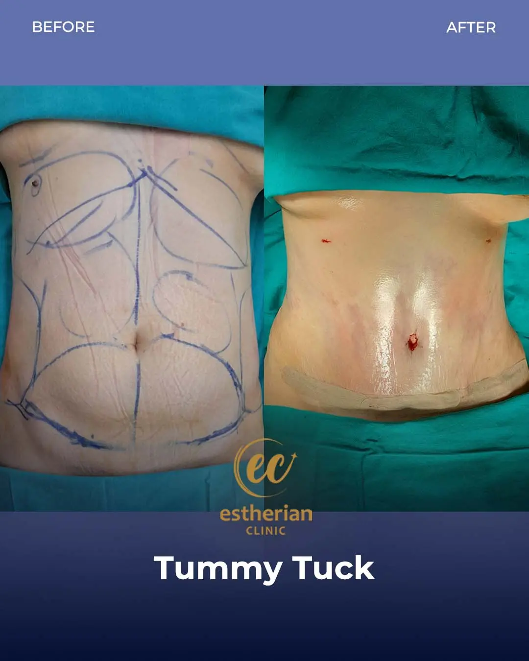 Tummy Tuck Before and after by the Estherian Clinic