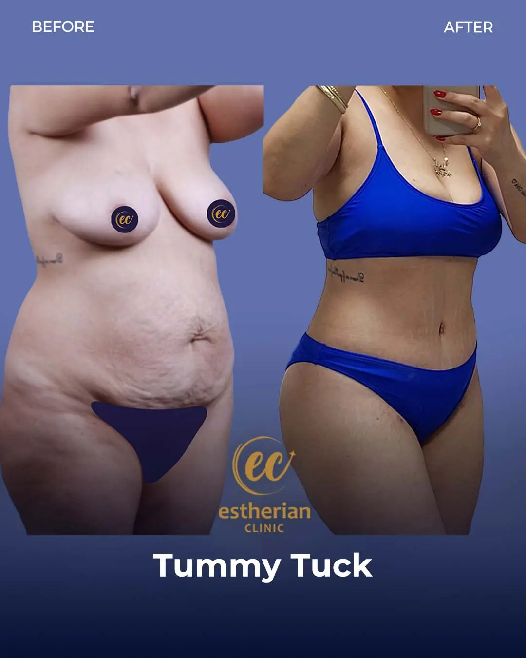 Tummy Tuck Before and after by the Estherian Clinic