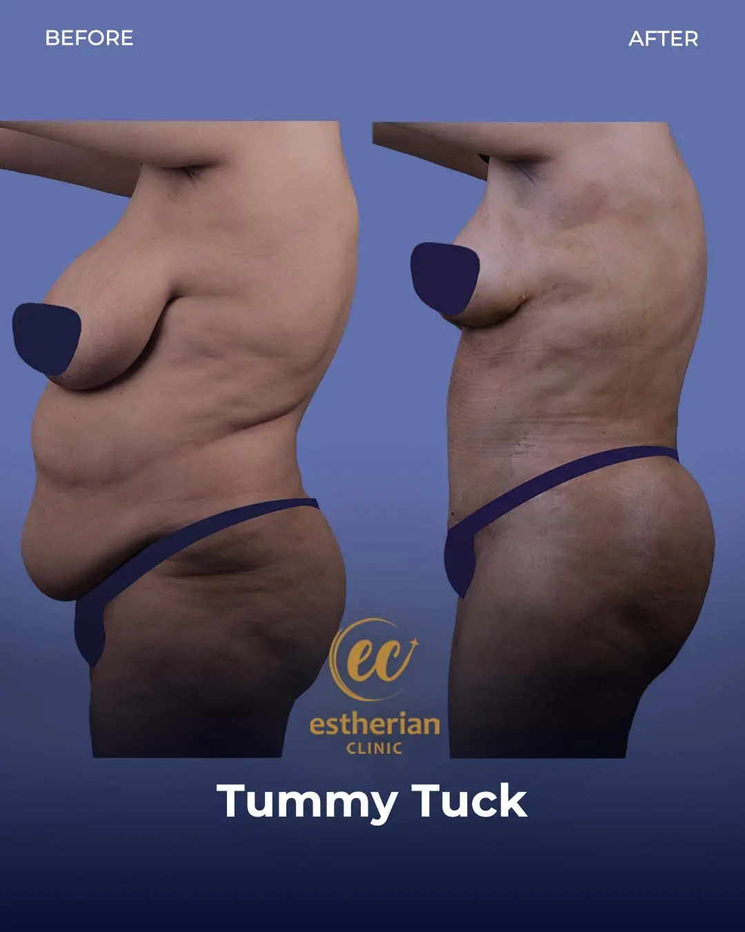 Tummy Tuck Before and after by the Estherian Clinic