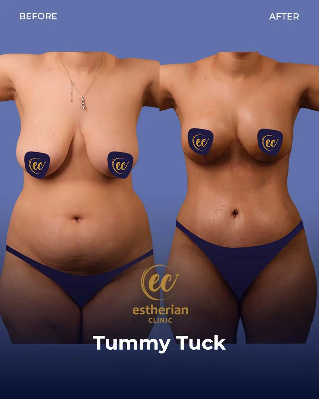 Tummy Tuck Before and after by the Estherian Clinic