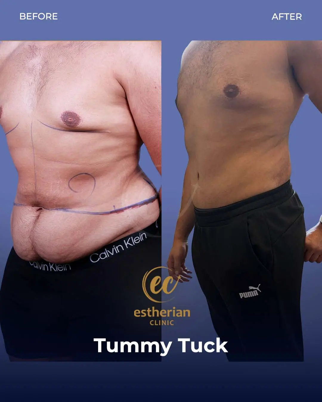 Male Tummy Tuck Before and after by the Estherian Clinic