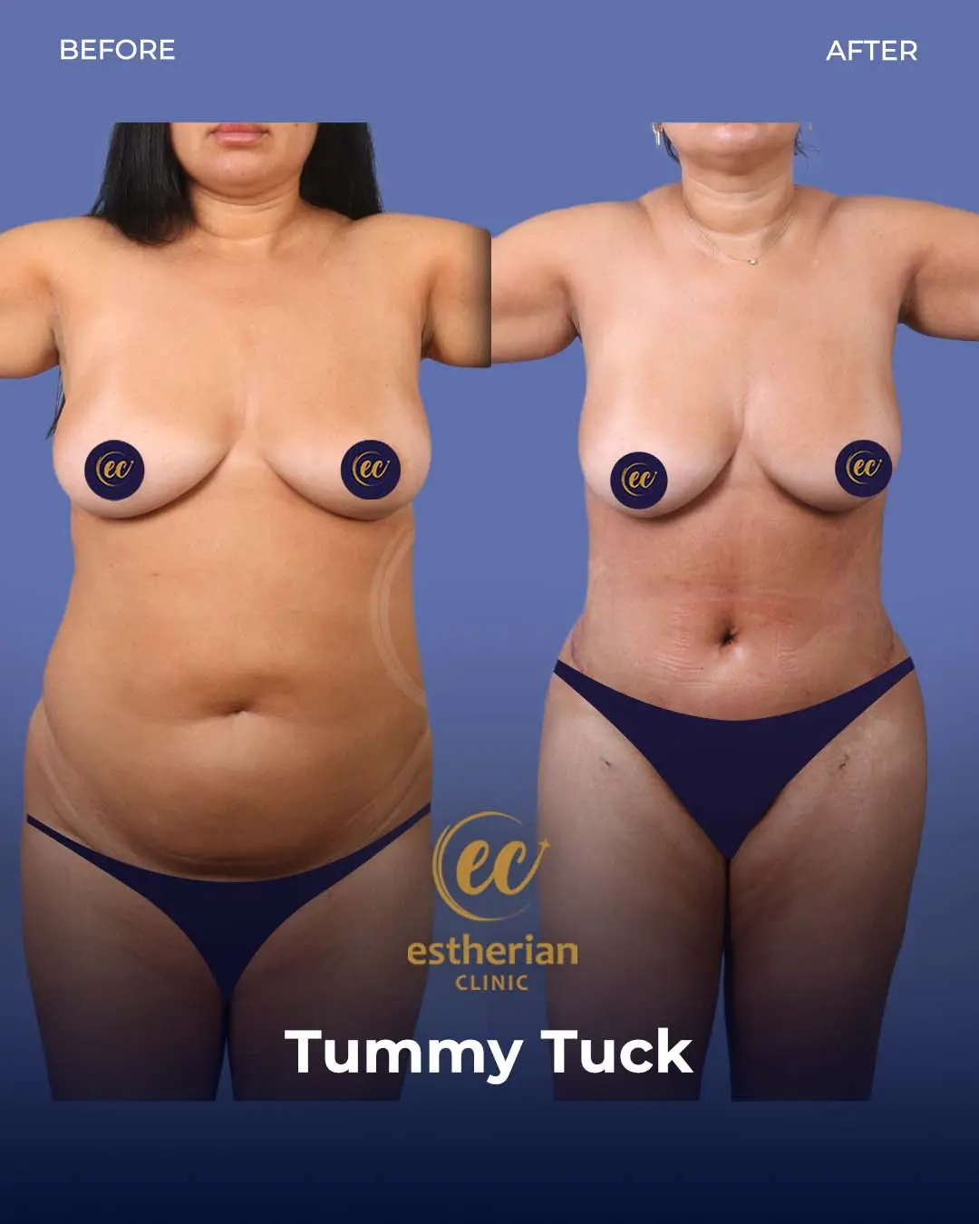 Tummy Tuck Before and after by the Estherian Clinic