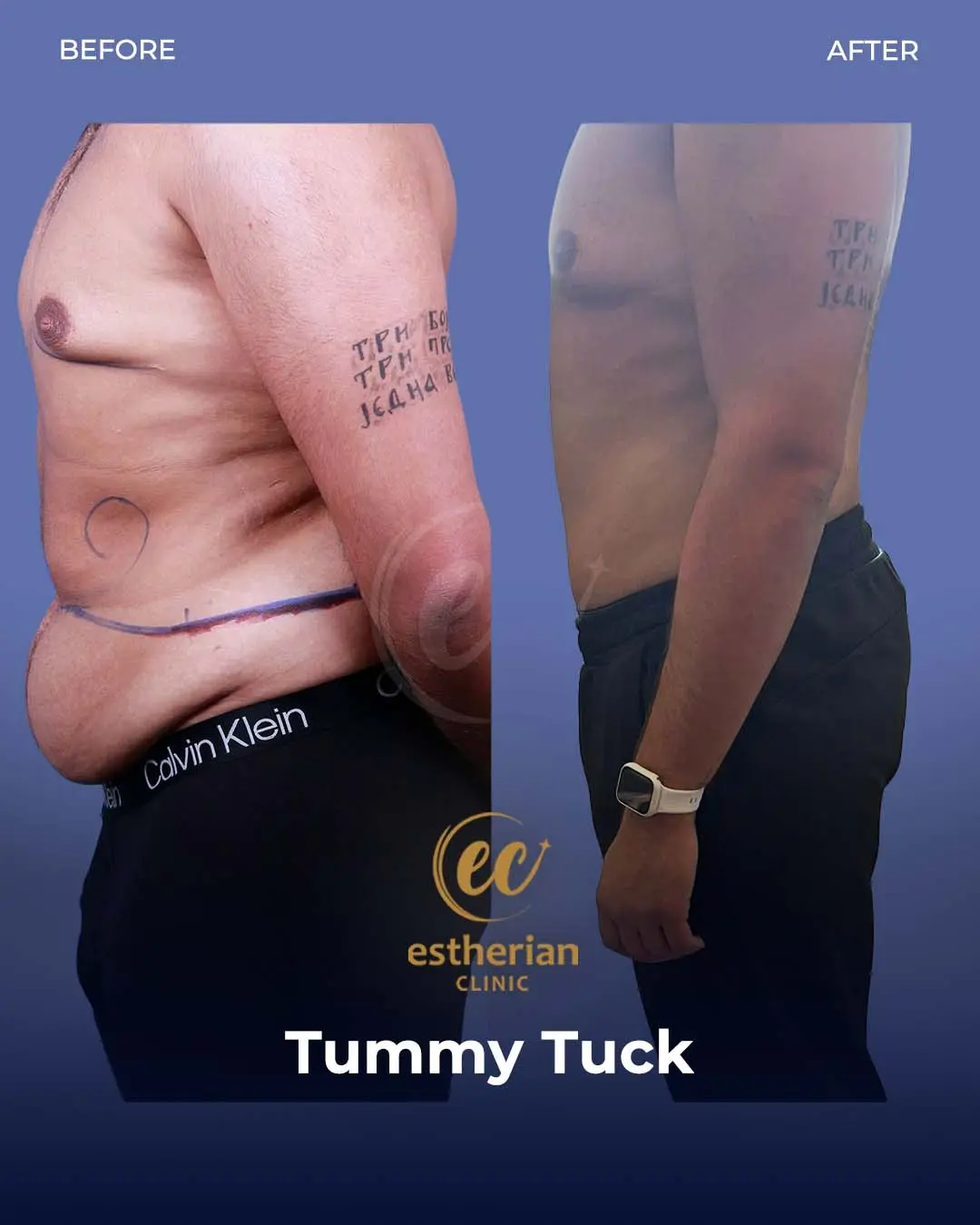 Male Tummy Tuck Before and after by the Estherian Clinic