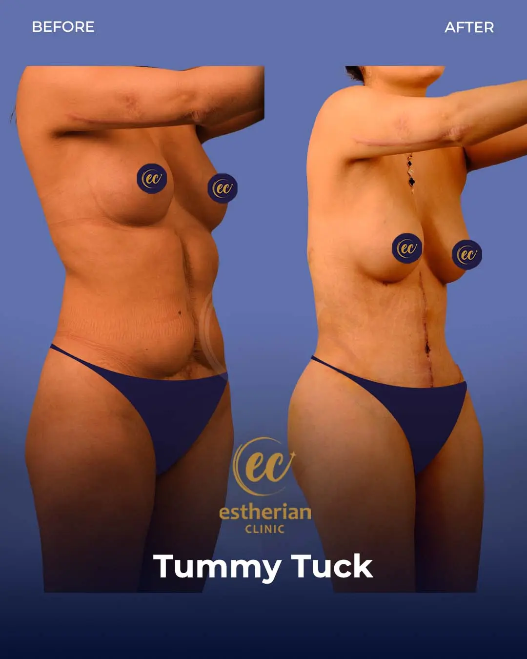 Tummy Tuck Before and after by the Estherian Clinic
