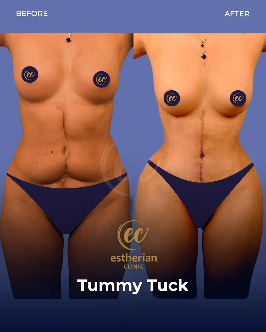 Tummy Tuck Before and after by the Estherian Clinic