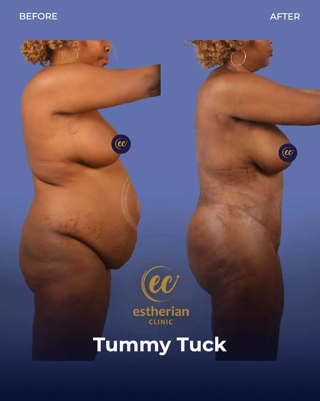 Tummy Tuck Before and after by the Estherian Clinic