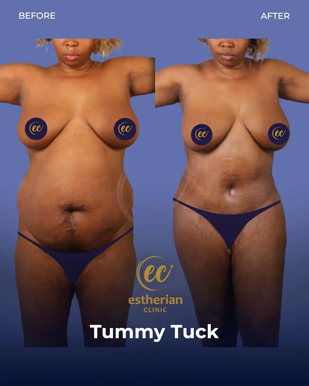 Tummy Tuck Before and after by the Estherian Clinic