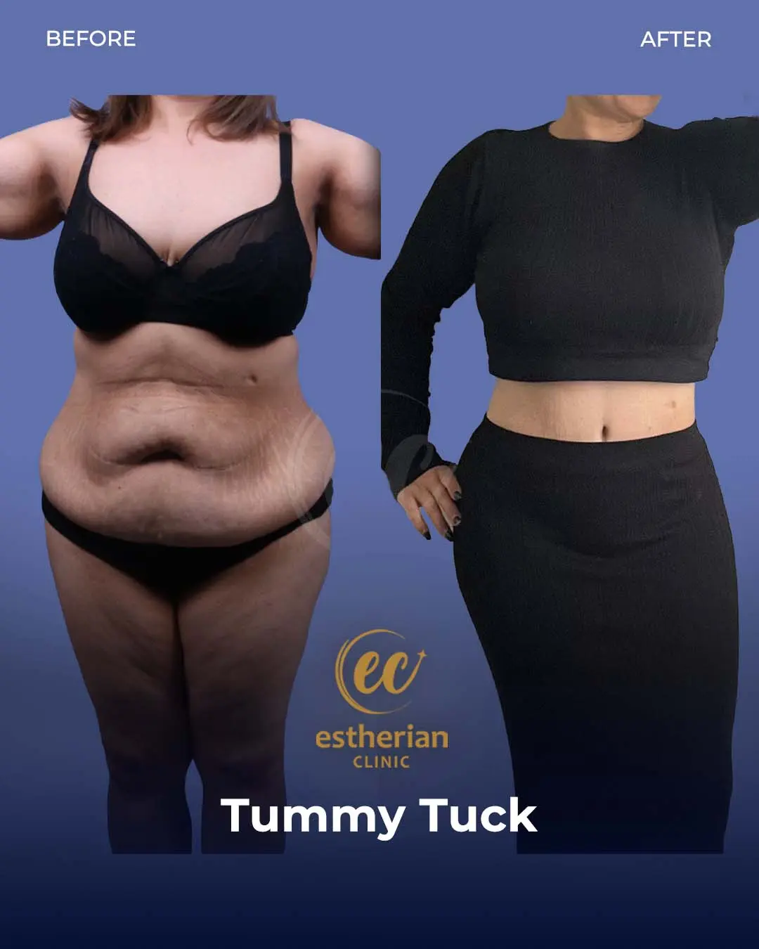 Tummy Tuck Before and after by the Estherian Clinic