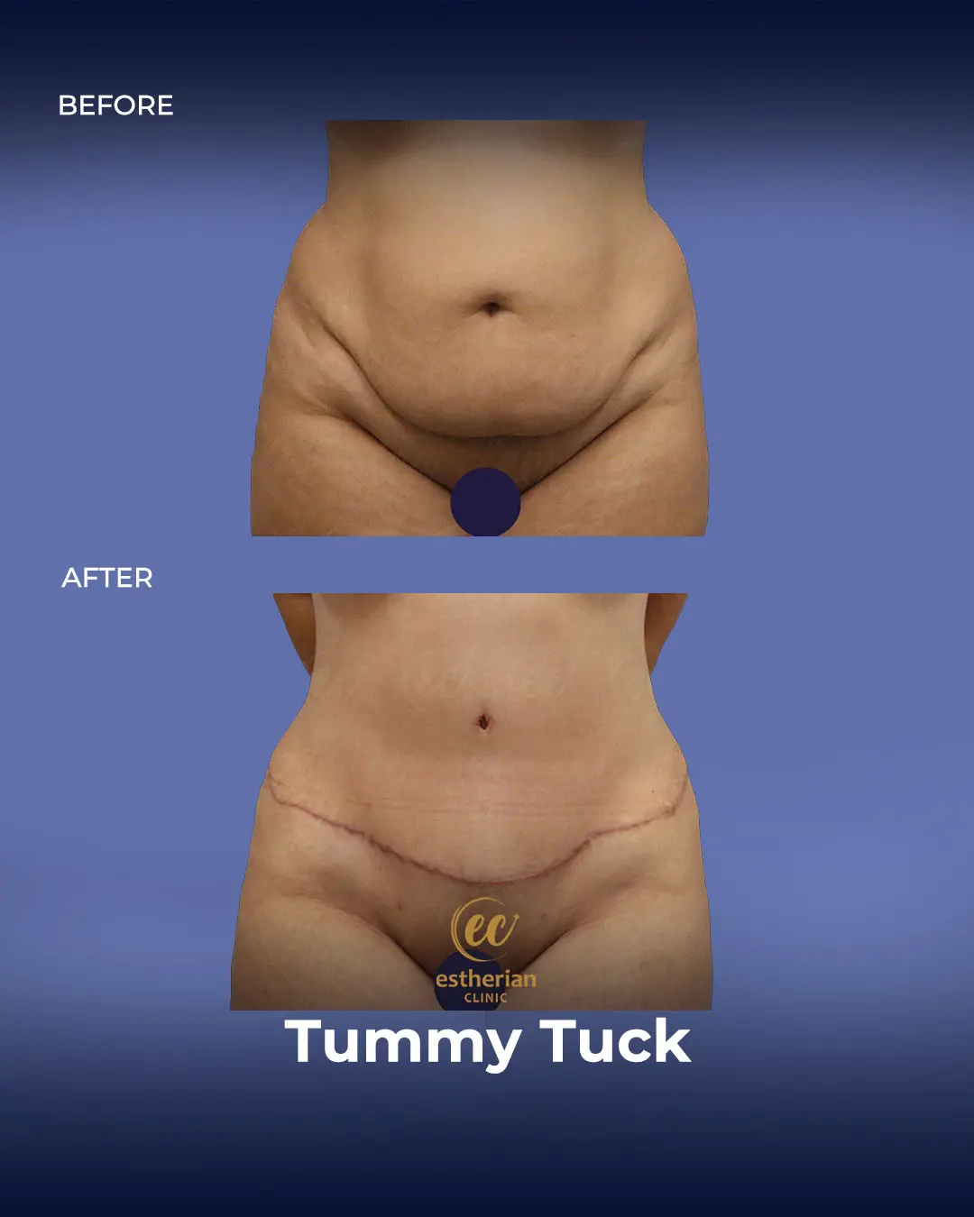 Tummy Tuck Before and after by the Estherian Clinic