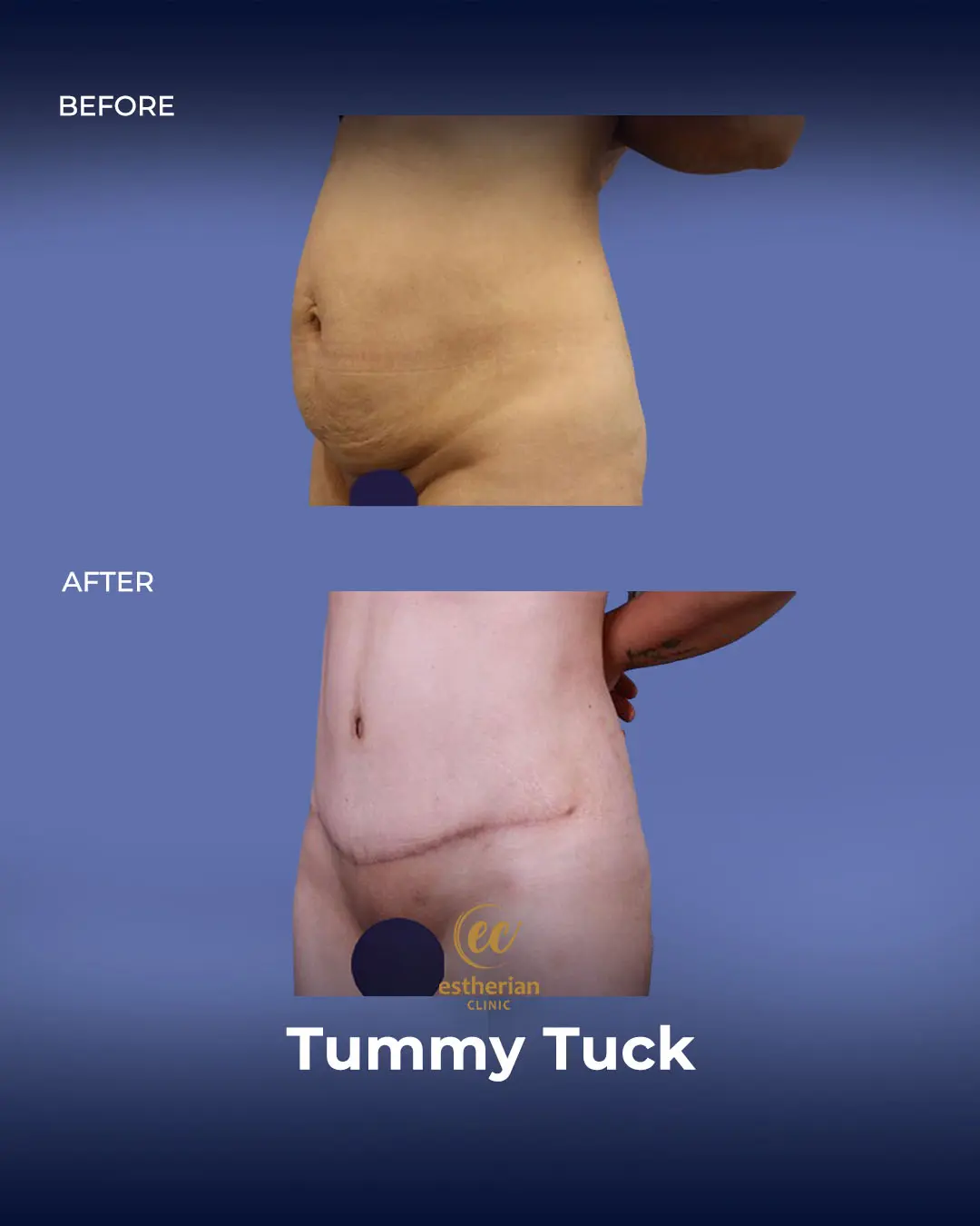 Tummy Tuck Before and after by the Estherian Clinic