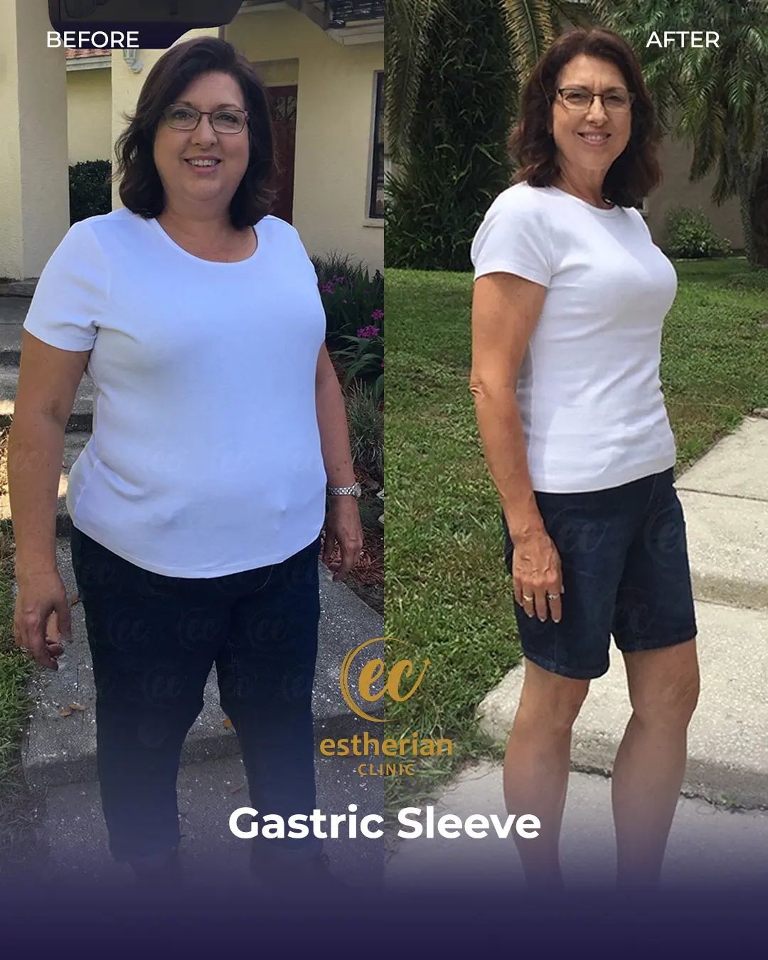 Gastric Sleeve Surgery (Bariatric Surgery) Before-and-after Real Patient Transformation by the Estherian Clinic
