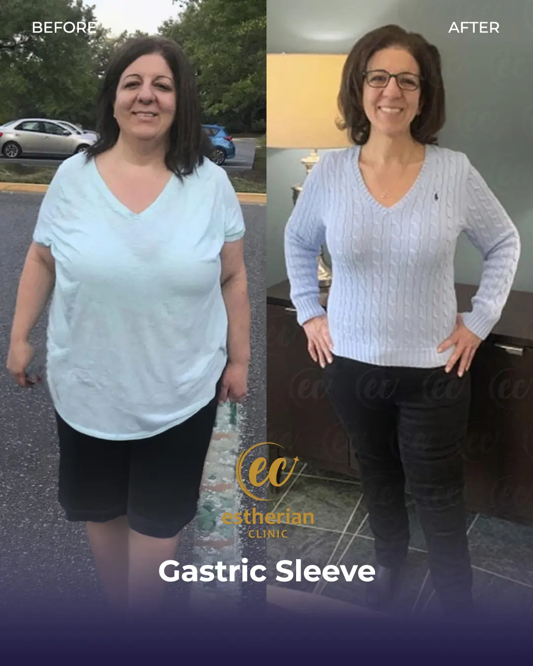 Gastric Sleeve Surgery (Bariatric Surgery) Before-and-after Real Patient Transformation by the Estherian Clinic