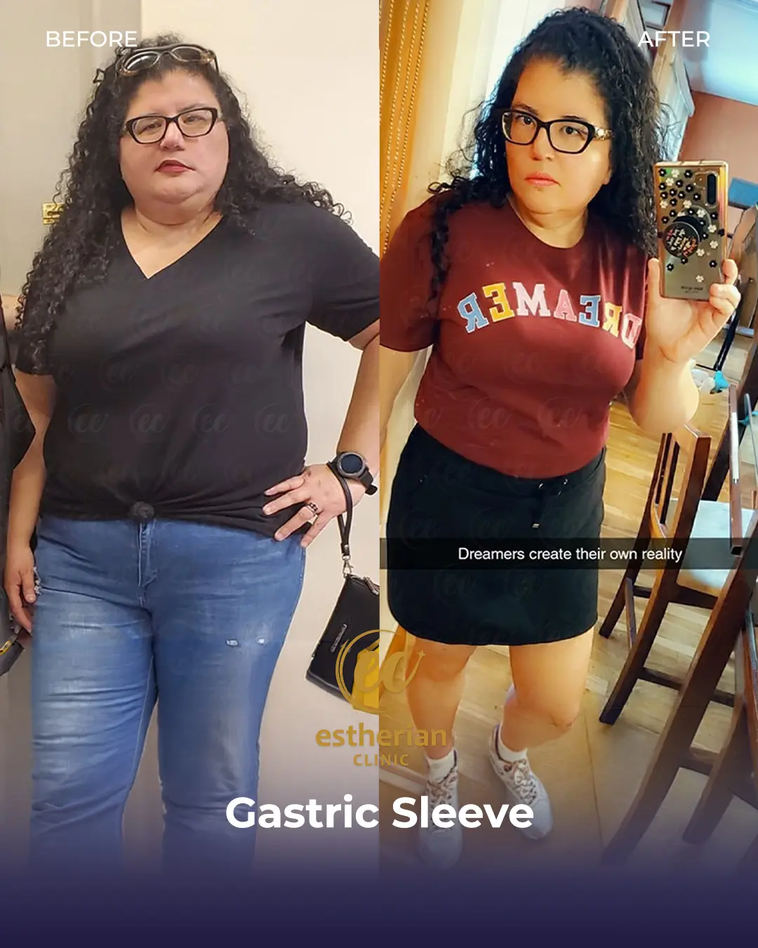 Gastric Sleeve Surgery (Bariatric Surgery) Before-and-after Real Patient Transformation by the Estherian Clinic