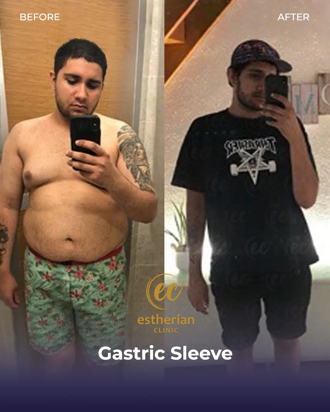 Gastric Sleeve Surgery (Bariatric Surgery) Before-and-after Real Patient Transformation by the Estherian Clinic